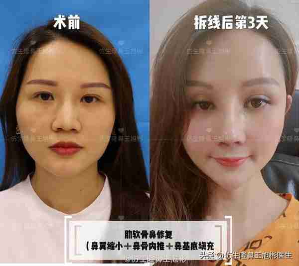 初鼻当心:硅胶假体隆鼻后,什么原因会造成包膜挛缩?可防可治吗