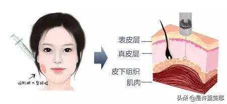 关于瘦脸针,你们想了解的都在这儿了