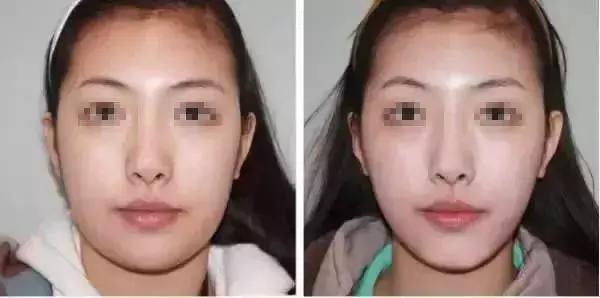你适合打瘦脸针吗?