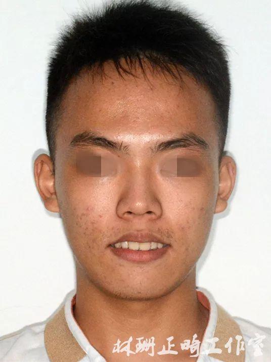 福州牙齿矫正 | 前突龅牙患者害怕骨钉,改用z钩获得很好的内收效果