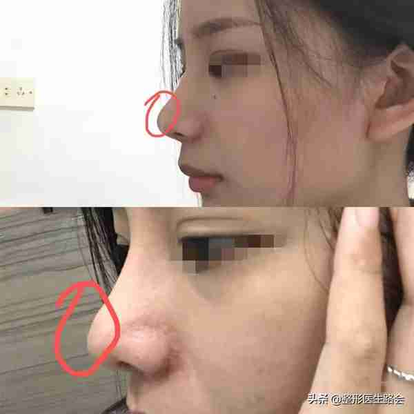为什么用硅胶+耳软骨隆鼻,容易“透光+下旋”?(隆鼻必看)