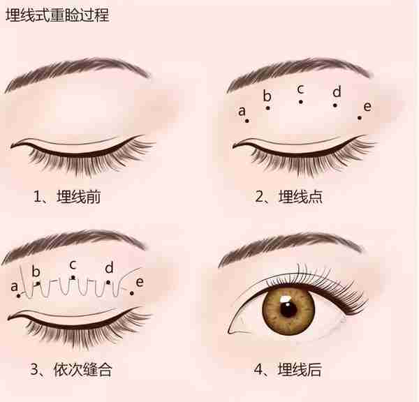 埋线双眼皮手术全过程