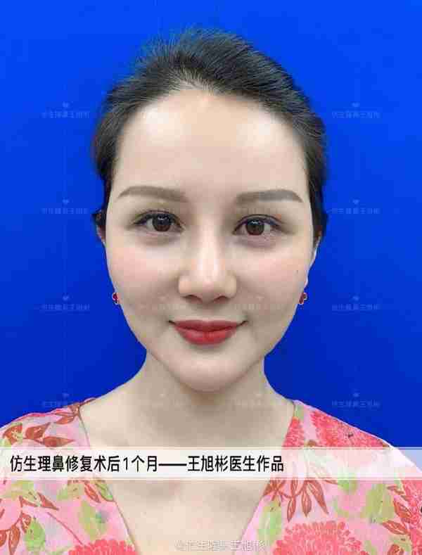 初鼻当心:硅胶假体隆鼻后,什么原因会造成包膜挛缩?可防可治吗