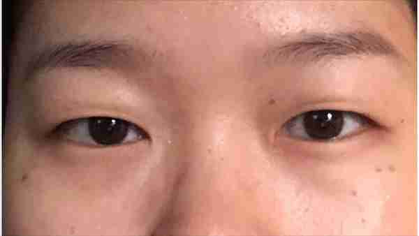 做个双眼皮要花1.5w元钱?为什么别人几百块就行?医生告诉您