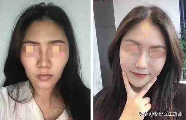 关于自体脂肪填充,那些整形医生不会告诉你的