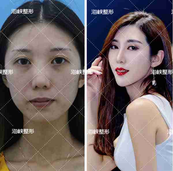 打瘦脸针10个人有2个脸会僵硬?想瘦脸怎么打才好呀