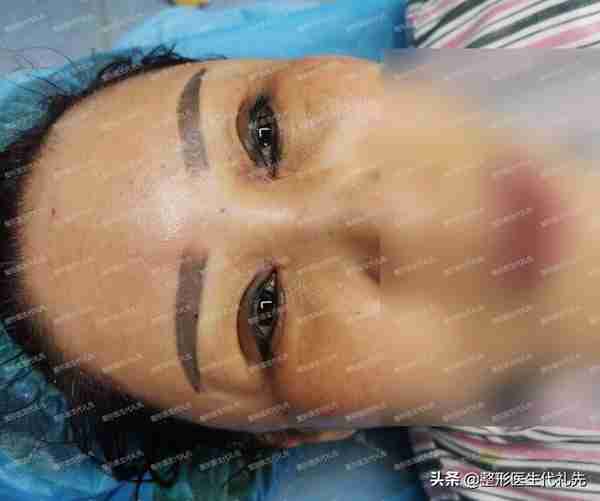 55岁忍受不了眼周皱纹凹陷,来北京做眼窝凹陷填充,全程真实记录