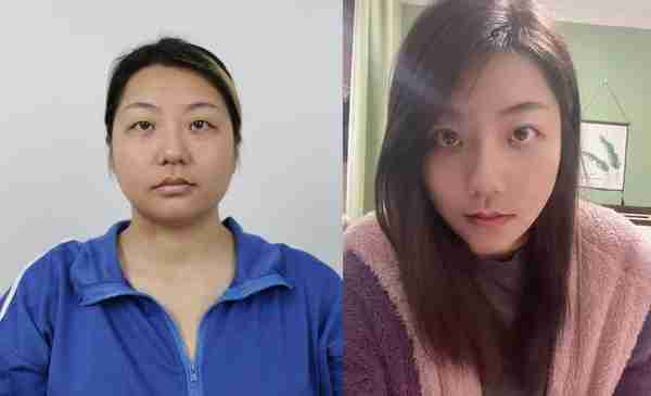 30岁小姐姐做完面部吸脂60天,朋友还以为我悄悄地换了一张脸