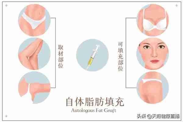 吸脂会让皮肤松垮?脂肪填充会移位?来听听八大处医生怎么说