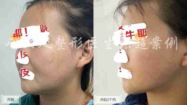 八大处张超面部吸脂反馈合集(五)