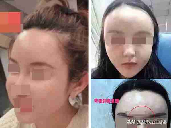 关于自体脂肪填充,那些整形医生不会告诉你的