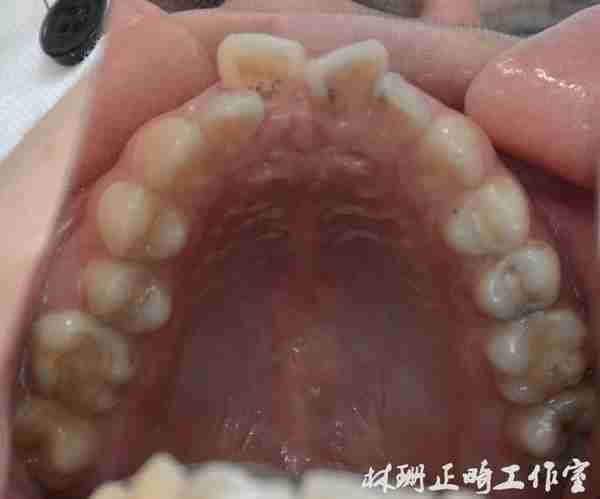 福州牙齿矫正 | 前突龅牙患者害怕骨钉,改用z钩获得很好的内收效果