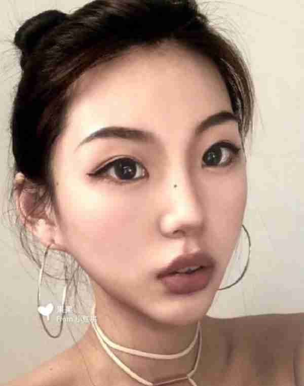 想要做成高级脸,鼻综合:肋软骨隆鼻