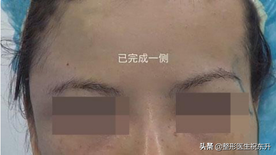 填充点脂肪,会导致脸下垂?脂肪表示不背这个"锅"
