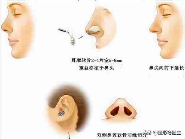 想要隆鼻!隆鼻手术种类形形色色,究竟怎么选?