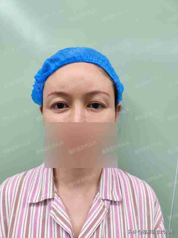 本身眼睛就长得非常好看,只想做个提眉手术恢复原来的双眼皮样子
