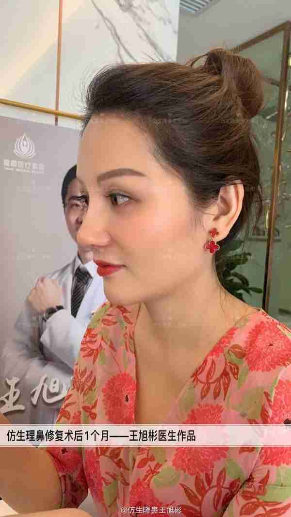 初鼻当心:硅胶假体隆鼻后,什么原因会造成包膜挛缩?可防可治吗