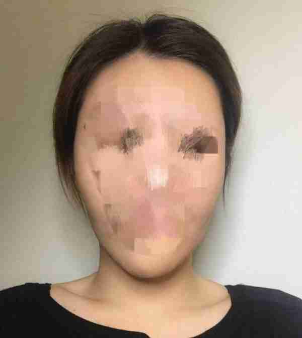 玻尿酸填充面颊，葫芦脸变鹅蛋脸
