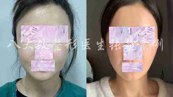 八大处张超面部吸脂反馈合集(五)