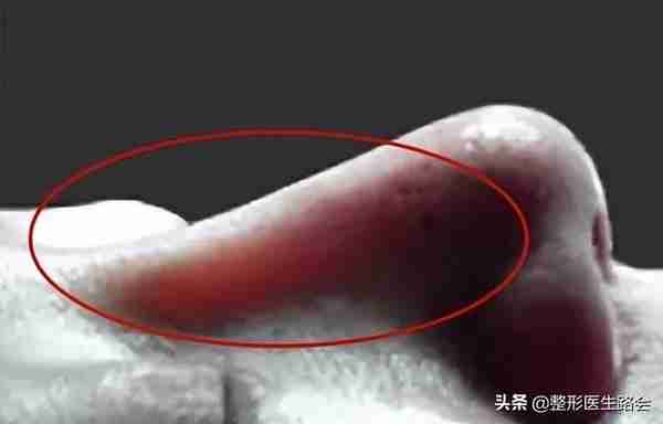 为什么用硅胶+耳软骨隆鼻,容易“透光+下旋”?(隆鼻必看)