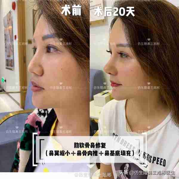 初鼻当心:硅胶假体隆鼻后,什么原因会造成包膜挛缩?可防可治吗