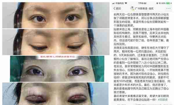 整形美容：不想被练手，割双眼皮花多少钱比较合适？