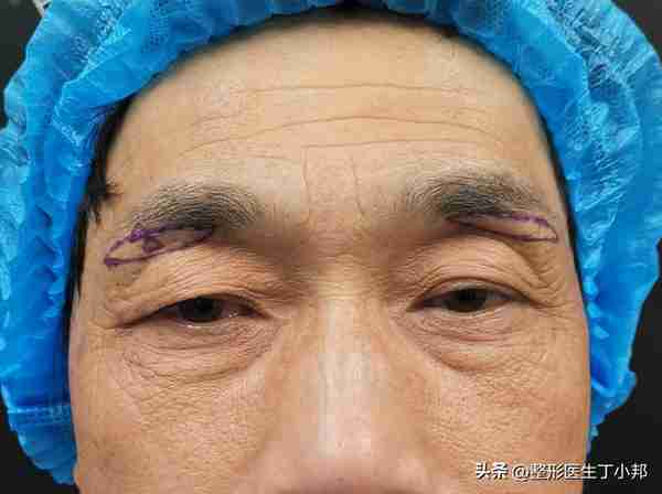 提眉术抗衰调整上睑提肌,也可以改善眯缝眼。#丁小邦面诊故事#