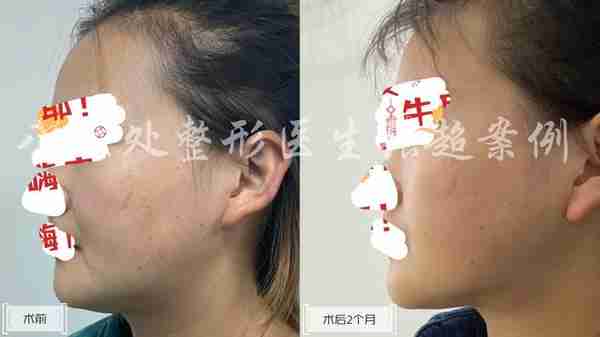 八大处张超面部吸脂反馈合集(五)