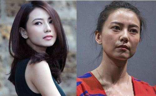 瘦脸针后遗症知多少,本人经历3年的教训,千万别因小失大