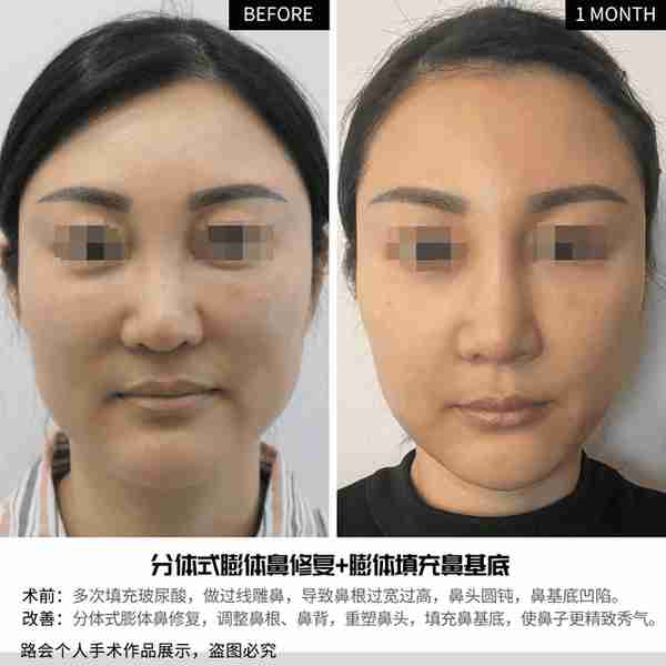 “玻尿酸隆鼻”是大热项目,简单快速,为什么我不建议大家做?