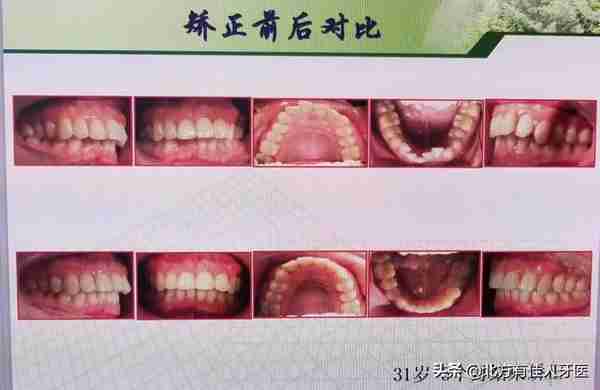 快速矫正有多快?一个月牙齿就整齐