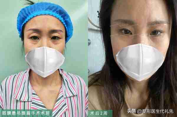 40岁后上眼睑松弛下垂了，提眉好还是全切双眼皮好？