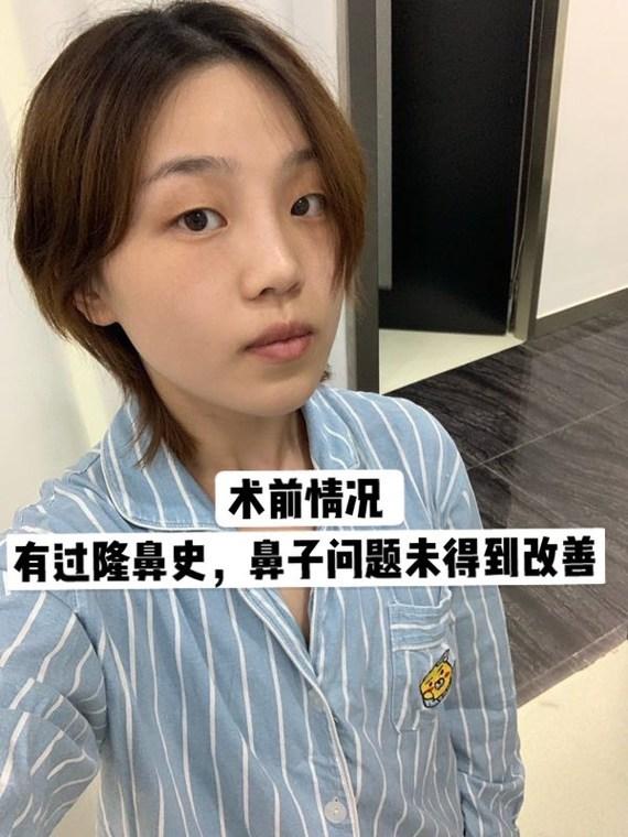 韩国医生整形日记:半肋软骨鼻修复案例分享