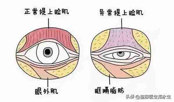 同样是割双眼皮,为什么有的人年轻了10岁,而有的人老了10岁?
