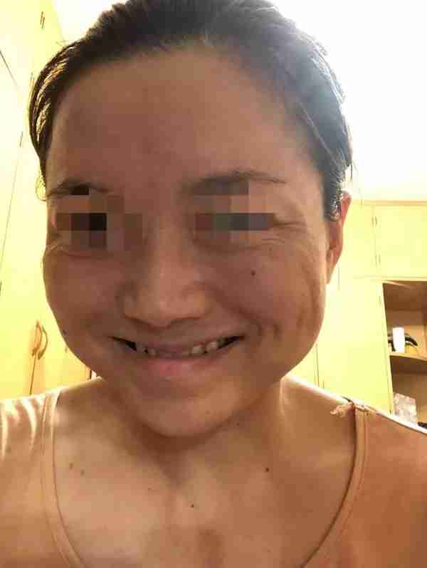 被瘦脸针“毁容”之后,索赔200万仅可得1万 法律保护健康但不保护美