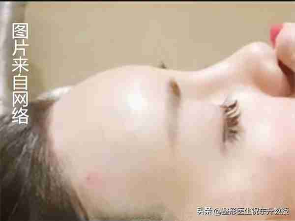 “脂肪填充害人不浅”? 我有不同的看法！把“亲身经历”讲给你听