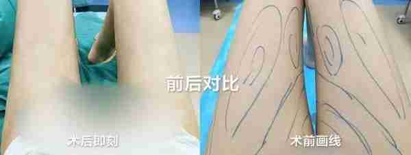 济南艺星大腿/腰腹环吸低￥6800！上臂吸脂￥4800