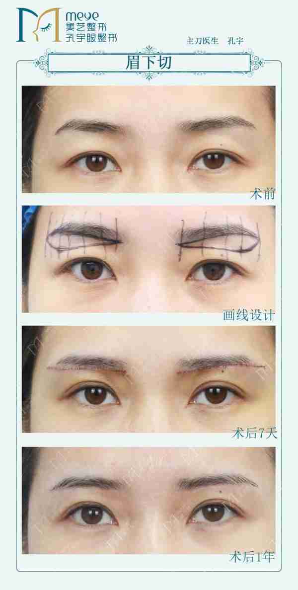 双眼皮想要内双变外双,不是说通过双眼皮就可以改善的