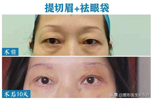 上眼皮松弛,要做手术"去皮、提上去"? 听听医生怎么说