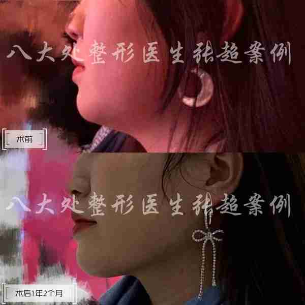 八大处张超面部吸脂反馈合集(五)