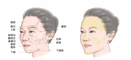 自体脂肪“面部填充”,一次解决五大“面部问题”...