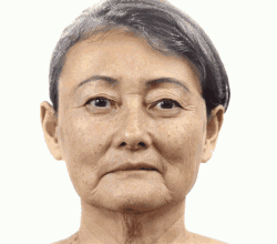 常见用于除皱的医美项目优缺点,我知道的内情
