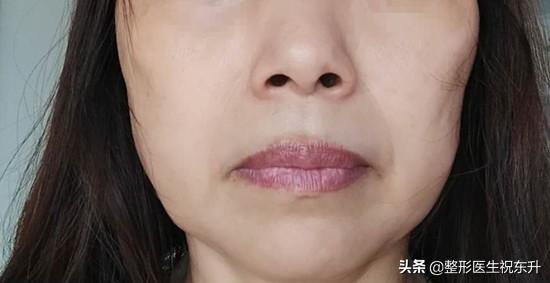 网上那么多“打完瘦脸针,出现面部僵硬、凹陷的”,我都不敢打了