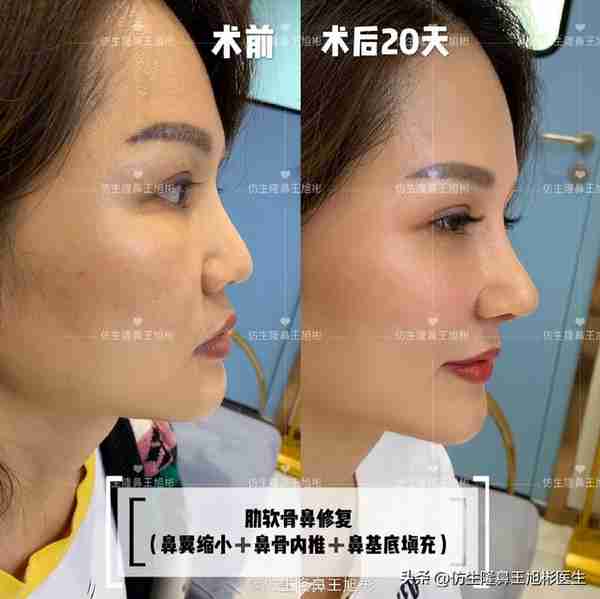 初鼻当心:硅胶假体隆鼻后,什么原因会造成包膜挛缩?可防可治吗