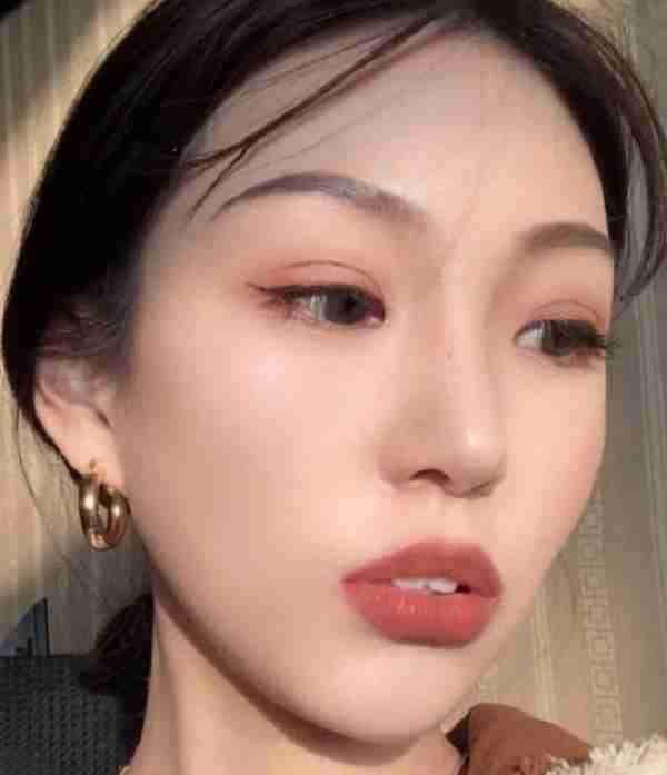 想要做成高级脸,鼻综合:肋软骨隆鼻