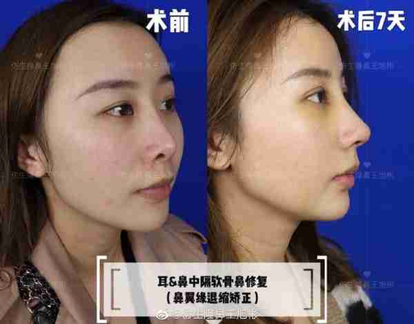 醒醒吧!L型假体隆鼻+耳软骨垫鼻尖,还在骗你是鼻综合