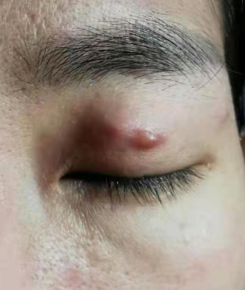 广西一美女割双眼皮,美容店老板切出“增生”还留疤