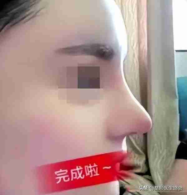 山西求美者:后悔死了!耳软骨垫鼻尖3年了,一直发红,怎么办?