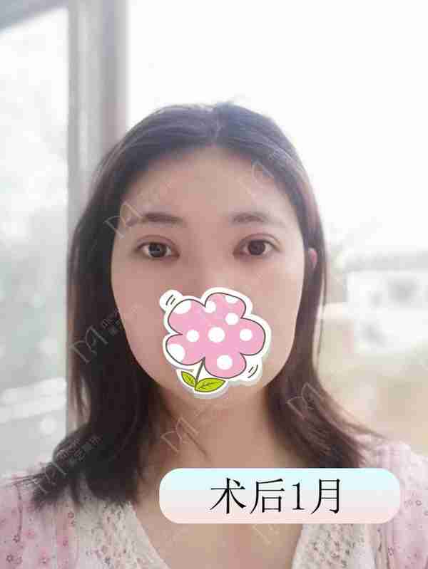 双眼皮术后出现肉条不要急着做双眼皮修复,要先分析原因。