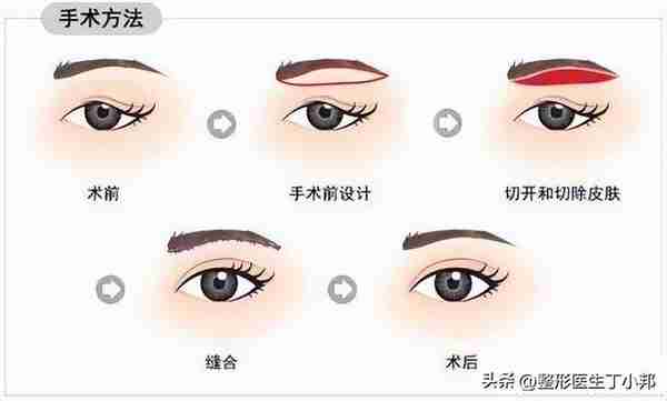 提眉术抗衰调整上睑提肌,也可以改善眯缝眼。#丁小邦面诊故事#
